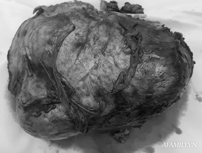 Bị tăng huyết áp và nữ hoá tuyến vú, người đàn ông suýt chết vì khối u lớn 'khủng khiếp' ở thận - Ảnh 3.