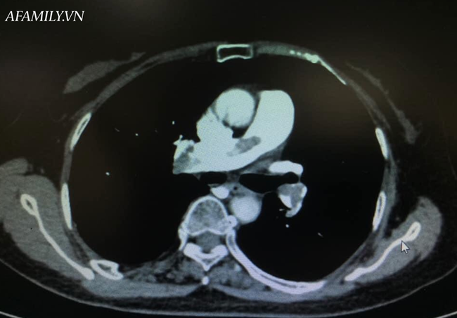 Vô tình gãy xương đùi, người phụ nữ nhập viện mới biết suýt chết vì căn bệnh rất nguy hiểm ở phổi - Ảnh 1.